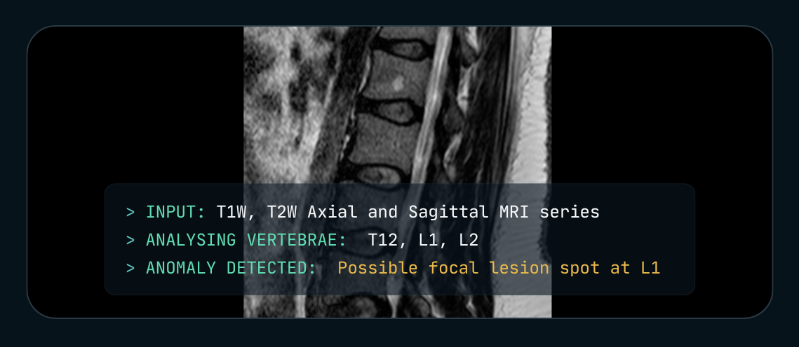 Cover Image for Reporting with Claude on MRI Spine images (T1W, T2W Sagittal and Axial)
